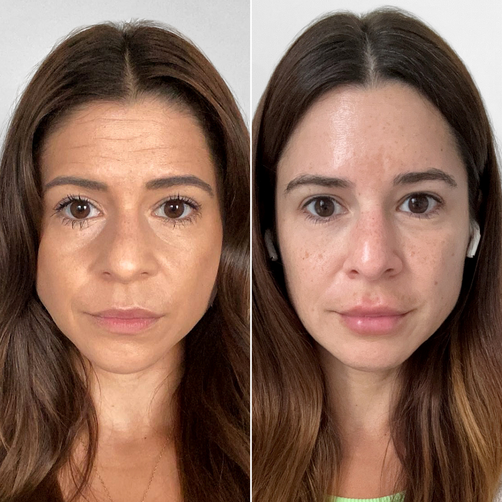 FaceFix: Liquid Face Lift – Beauty Fix MedSpa