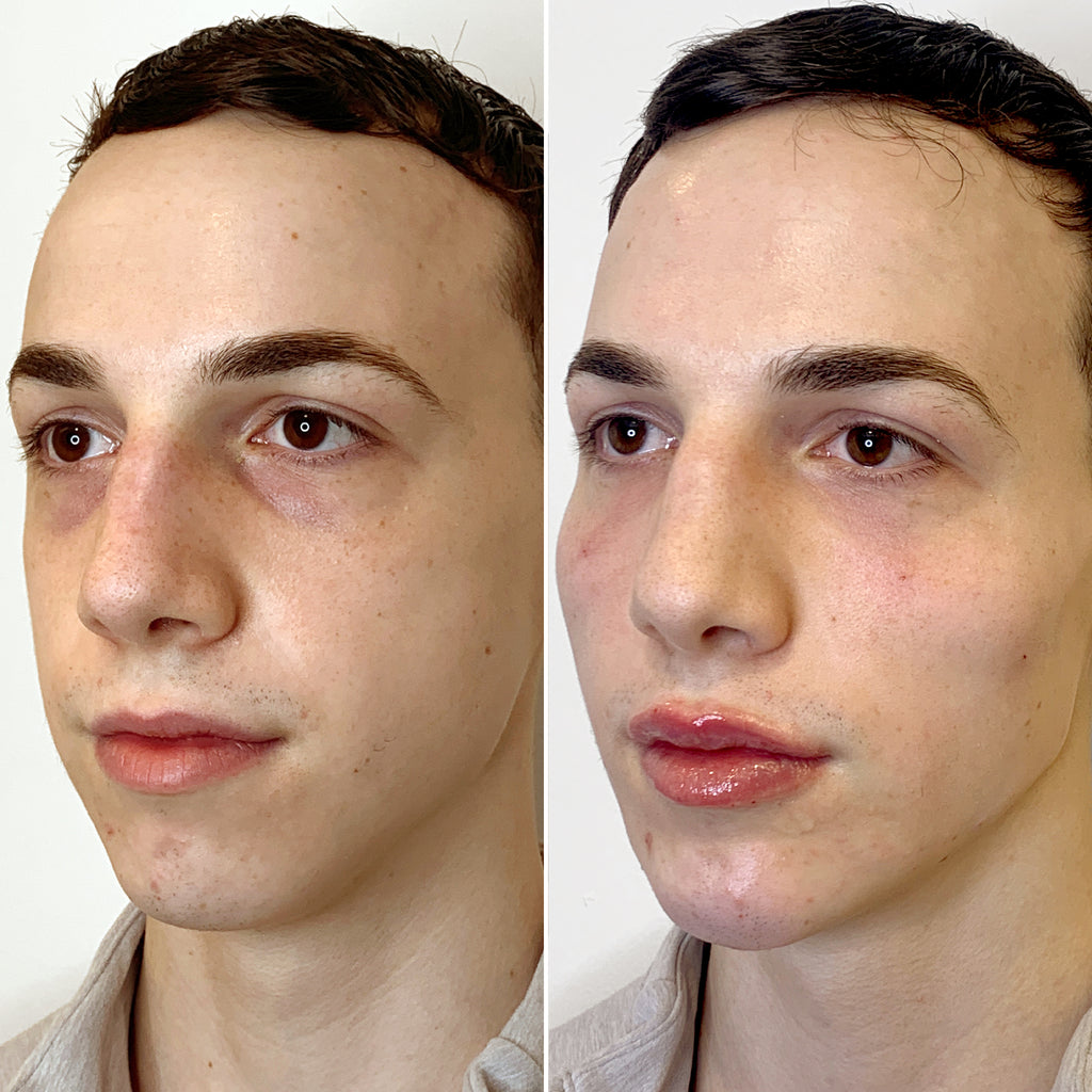 FaceFix: Face Lift for Men – Beauty Fix MedSpa