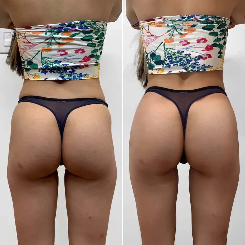 BootyFix: Radiesse Butt Lift – Beauty Fix MedSpa