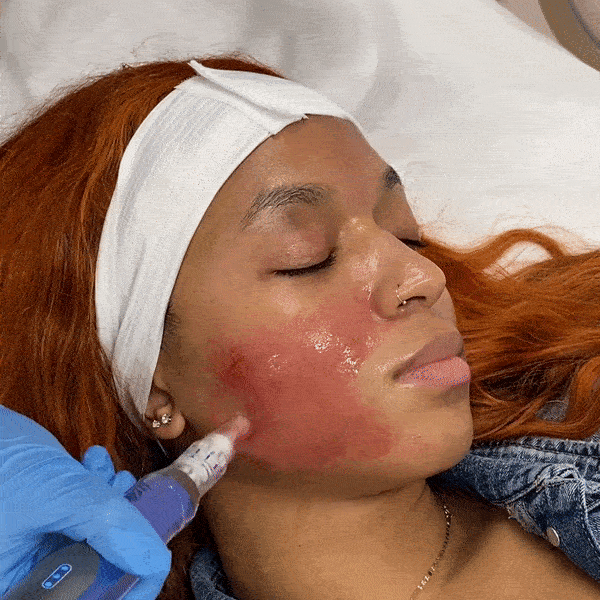 SkinFix: Microneedling – Beauty Fix MedSpa
