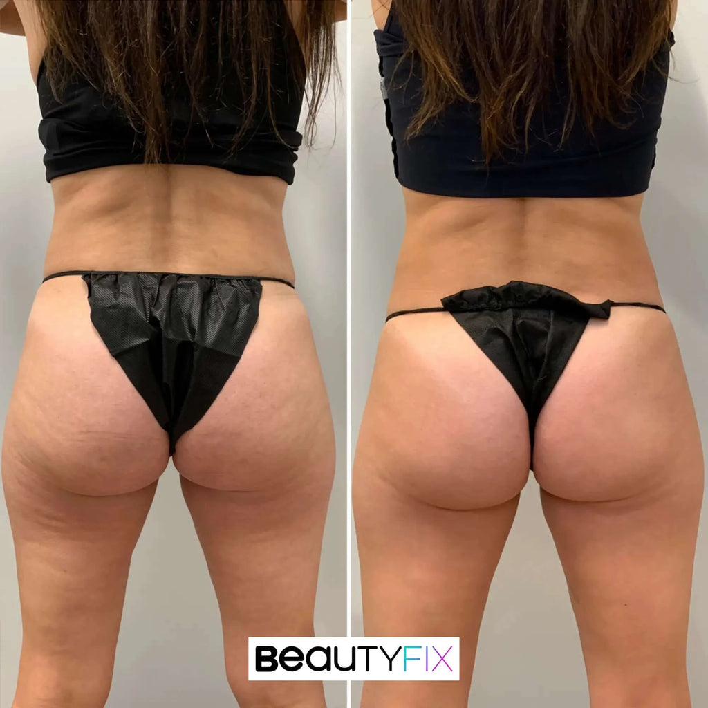 BodyFix: truSculpt flex – Beauty Fix MedSpa
