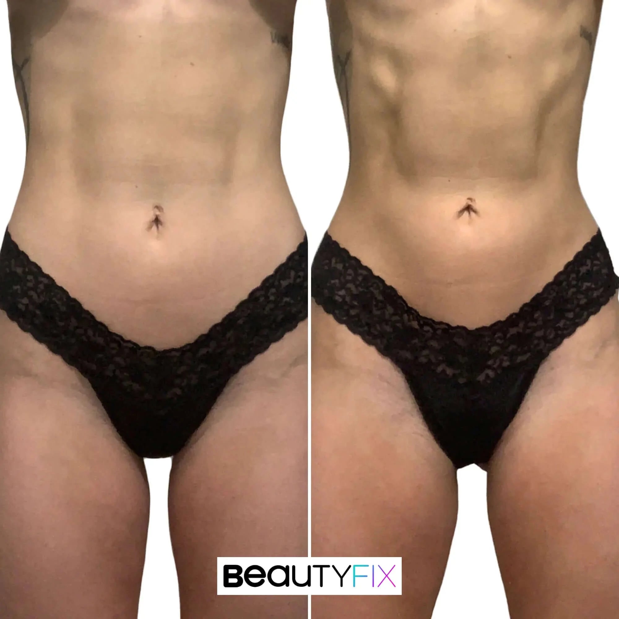 AbFix: truSculpt® flex – Beauty Fix MedSpa