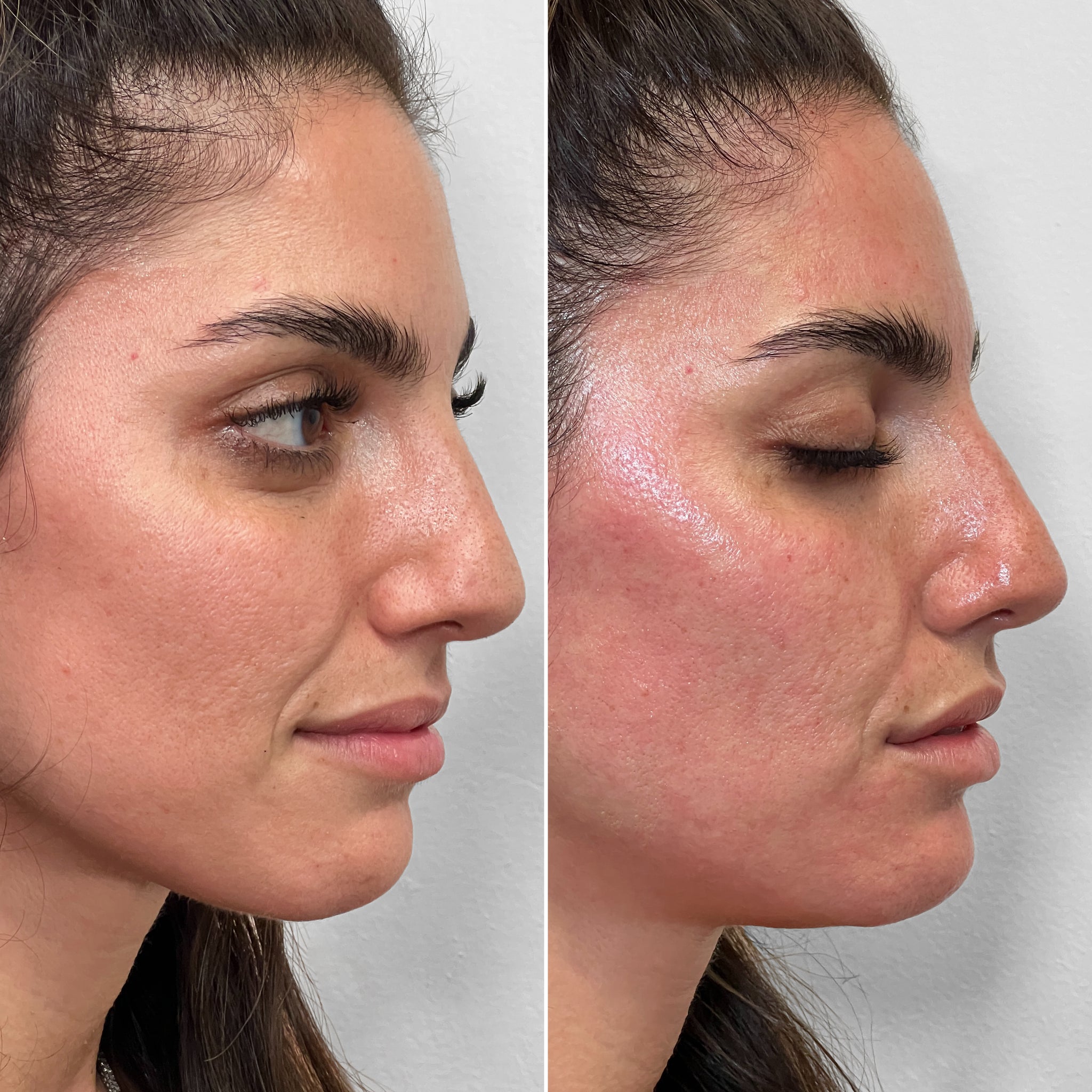 FaceFix: Salmon DNA – Beauty Fix MedSpa