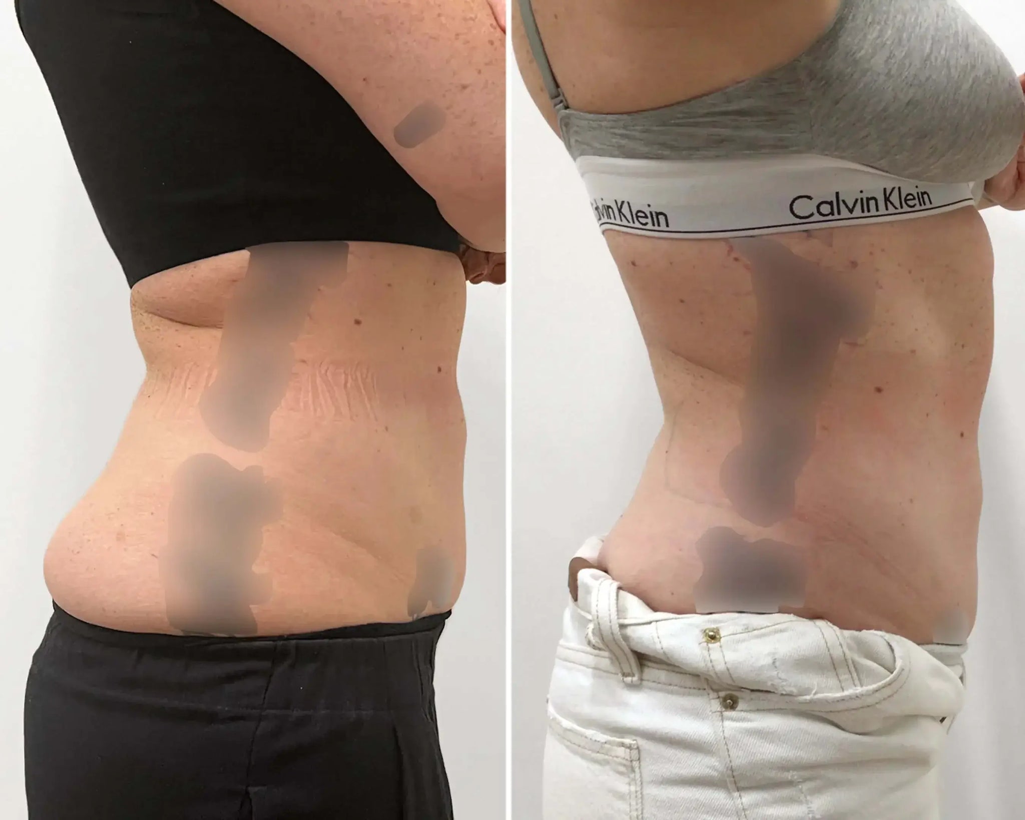 AbFix: CoolSculpting – Beauty Fix MedSpa