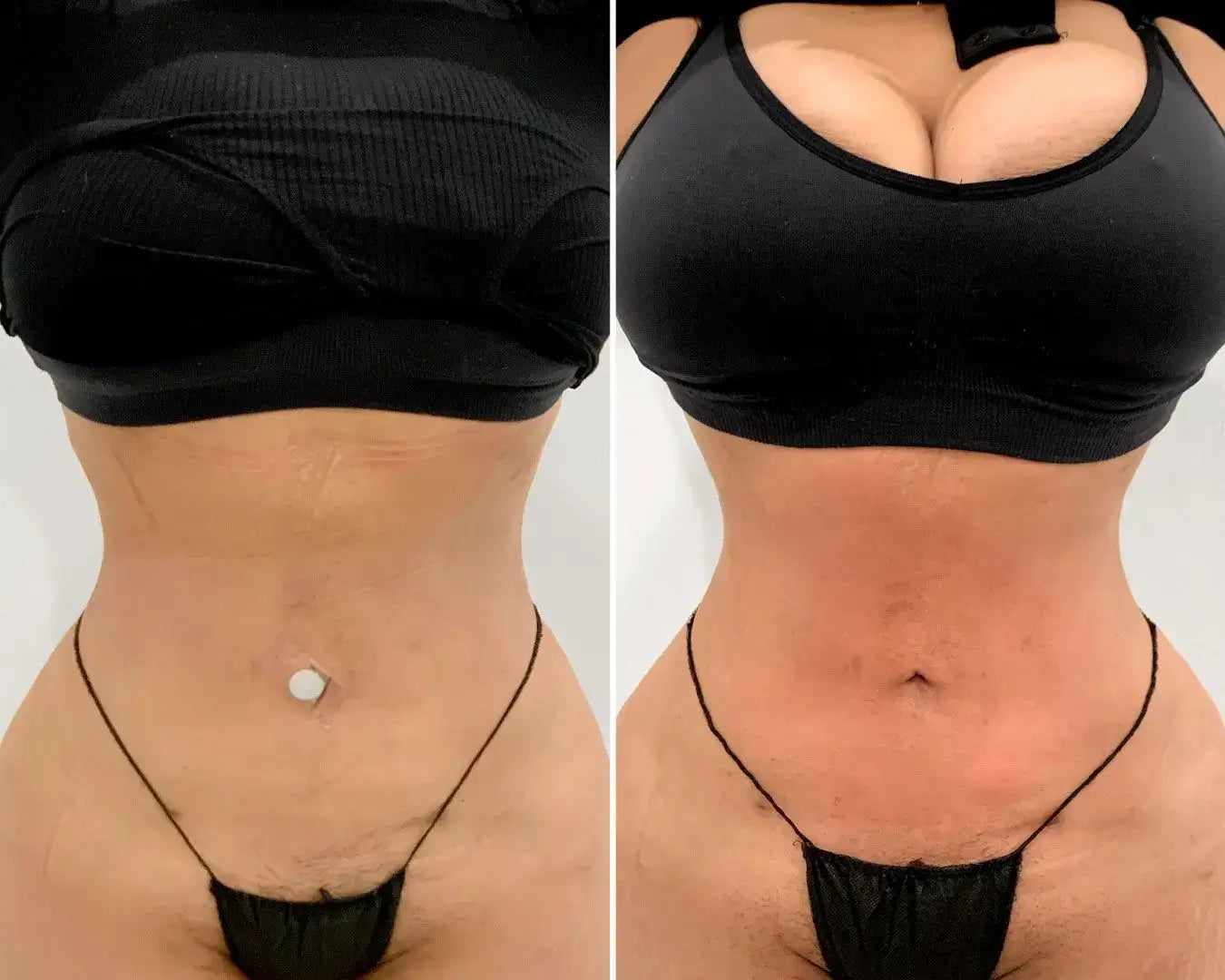 Post-OpFix: Z Wave – Beauty Fix MedSpa