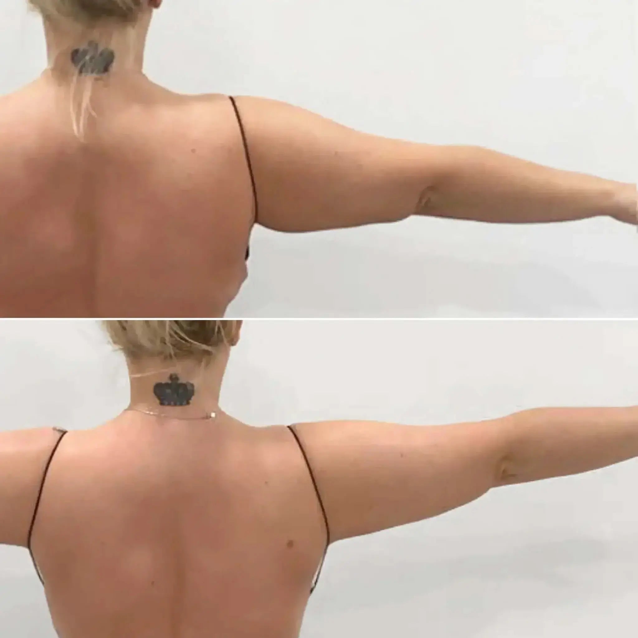 BodyFix: Liposuction – Beauty Fix MedSpa