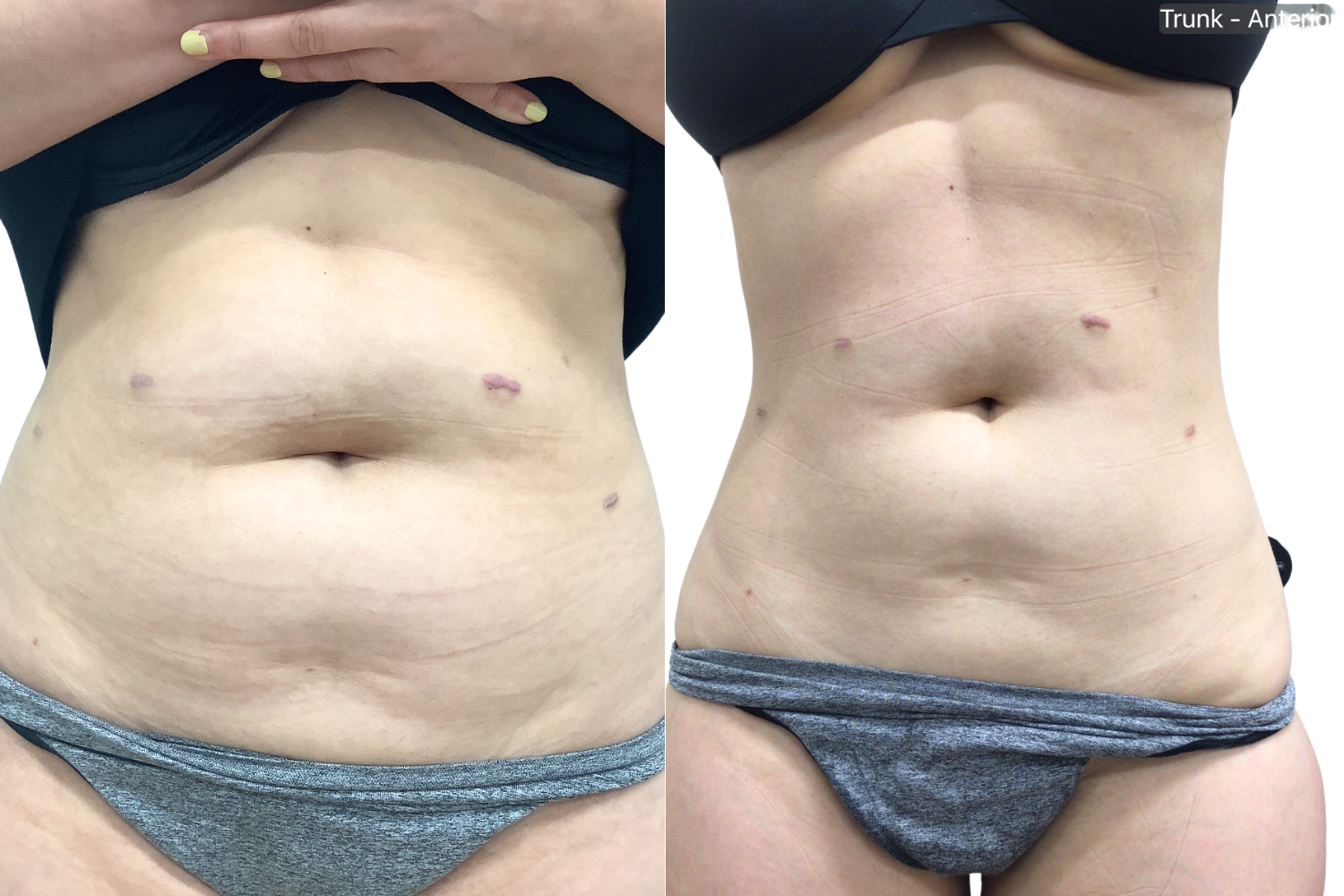 AbFix: truSculpt iD – Beauty Fix MedSpa