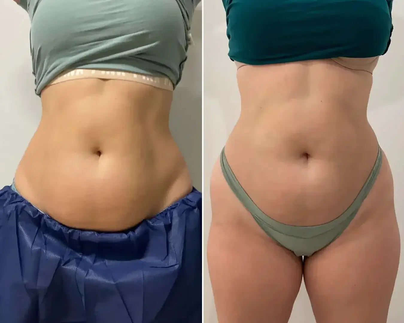 BodyFix: CoolSculpting® Elite – Beauty Fix MedSpa