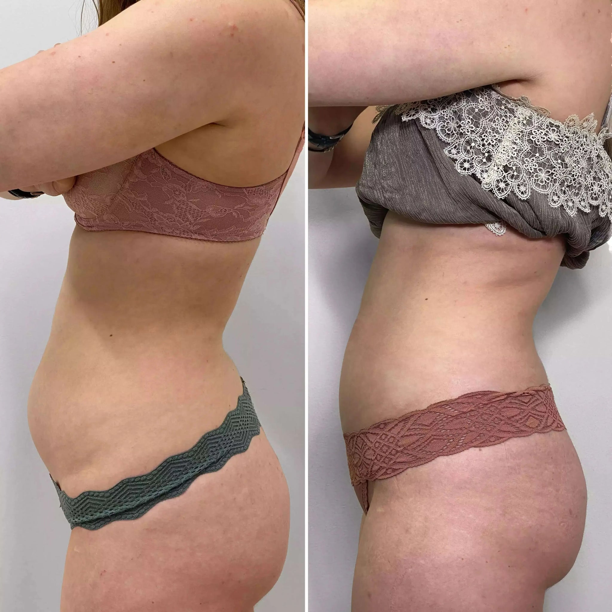 BodyFix: CoolSculpting® Elite – Beauty Fix MedSpa