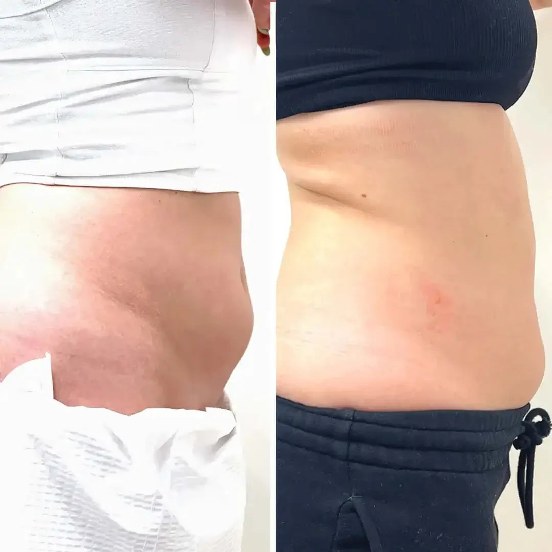 AbFix: CoolSculpting – Beauty Fix MedSpa