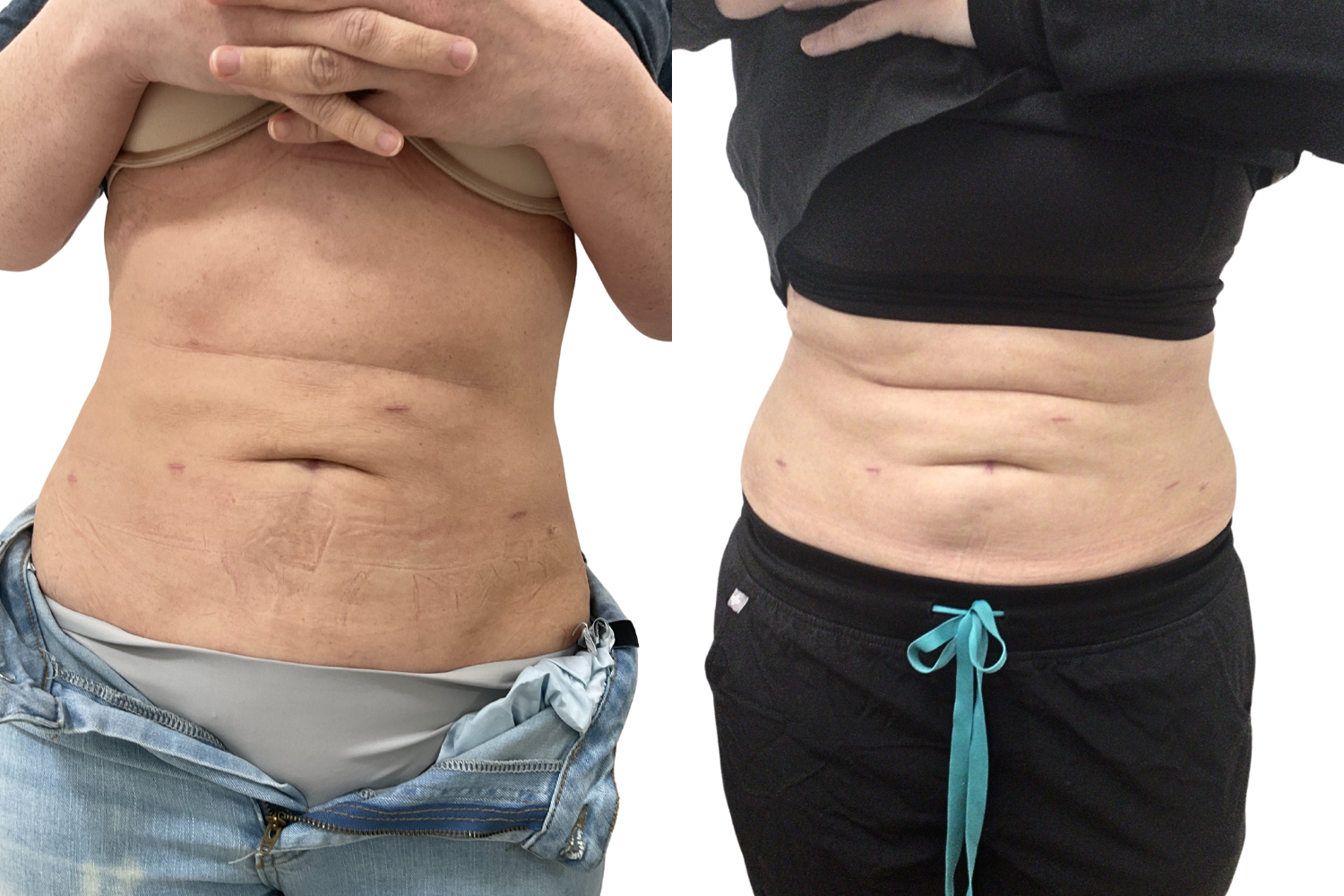 AbFix: truSculpt iD – Beauty Fix MedSpa
