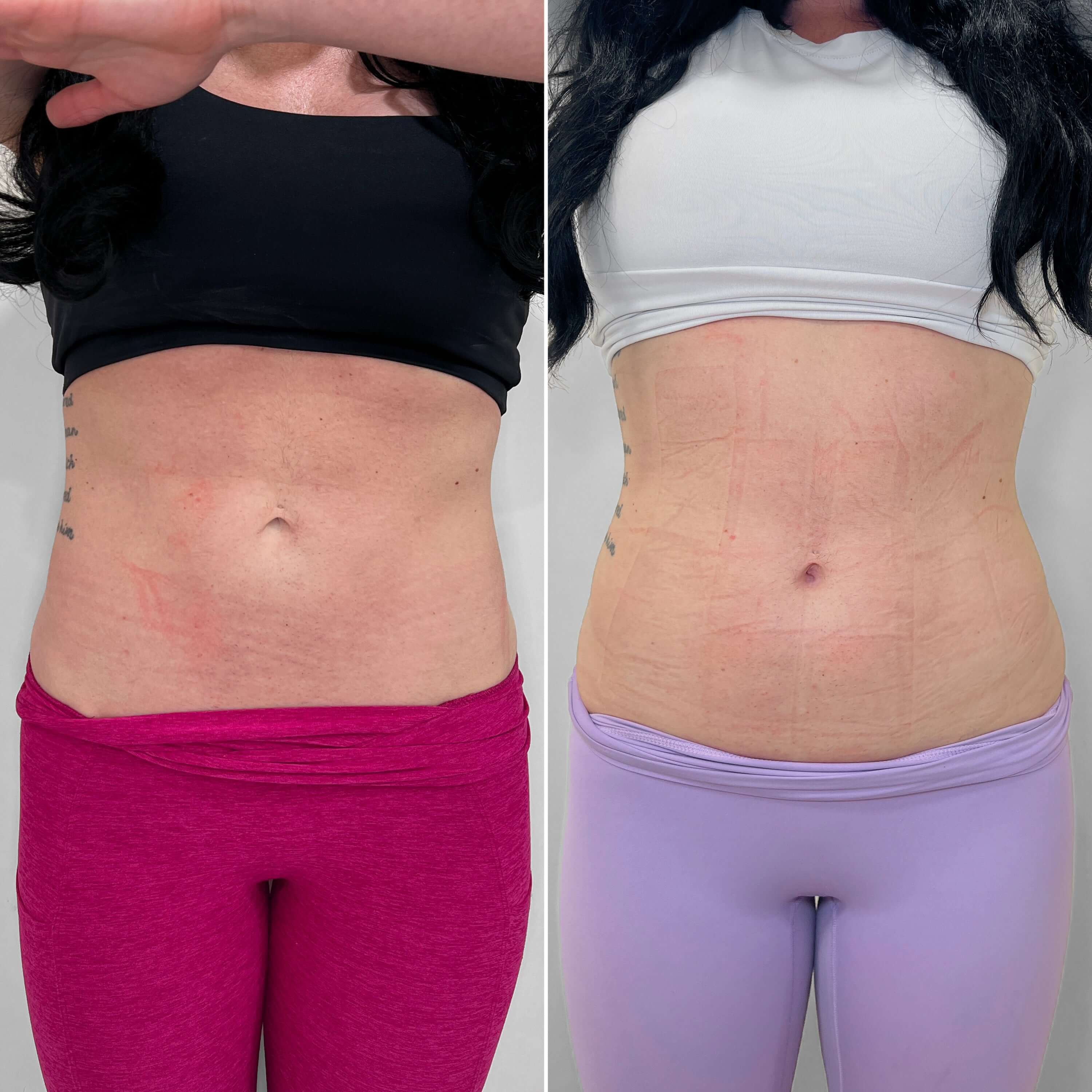 BootyFix:truSculpt flex in NYC | BeautyFix MedSpa UES - (212) 366-4787