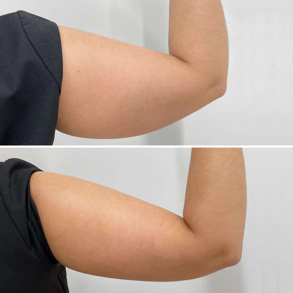 BodyFix: CoolSculpting® Elite – Beauty Fix MedSpa