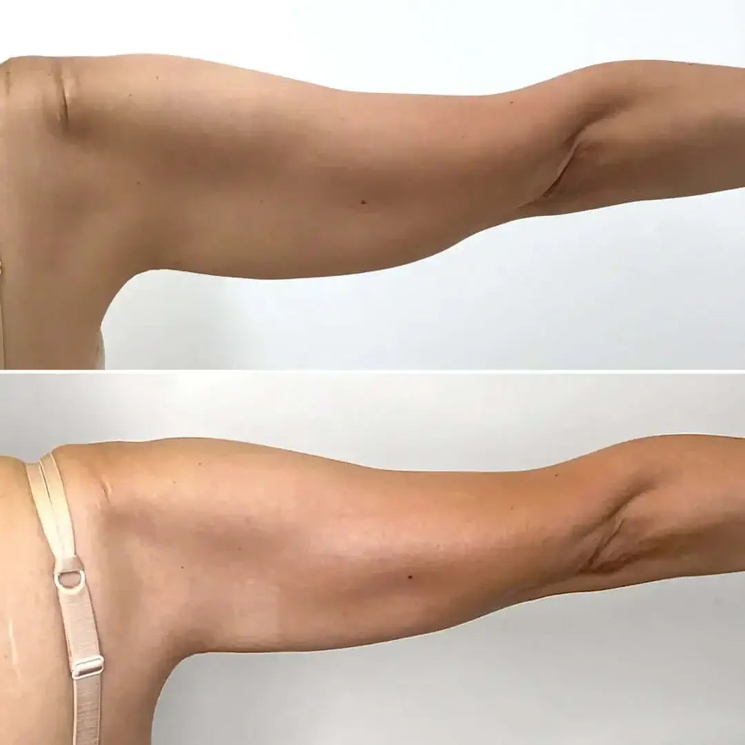 BodyFix: Morpheus8 – Beauty Fix MedSpa