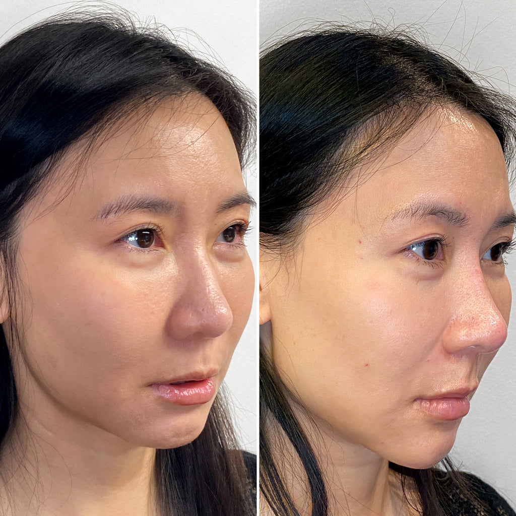 FaceFix: Liquid Face Lift – Beauty Fix MedSpa