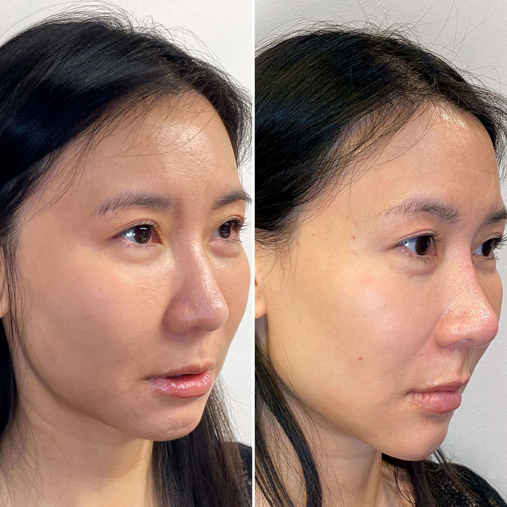 FaceFix: Liquid Face Lift – Beauty Fix MedSpa