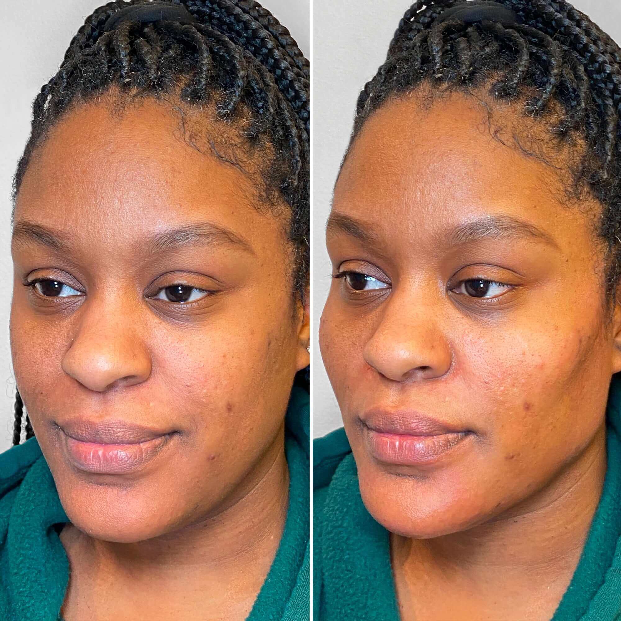 JawlineFix: Filler – Beauty Fix MedSpa