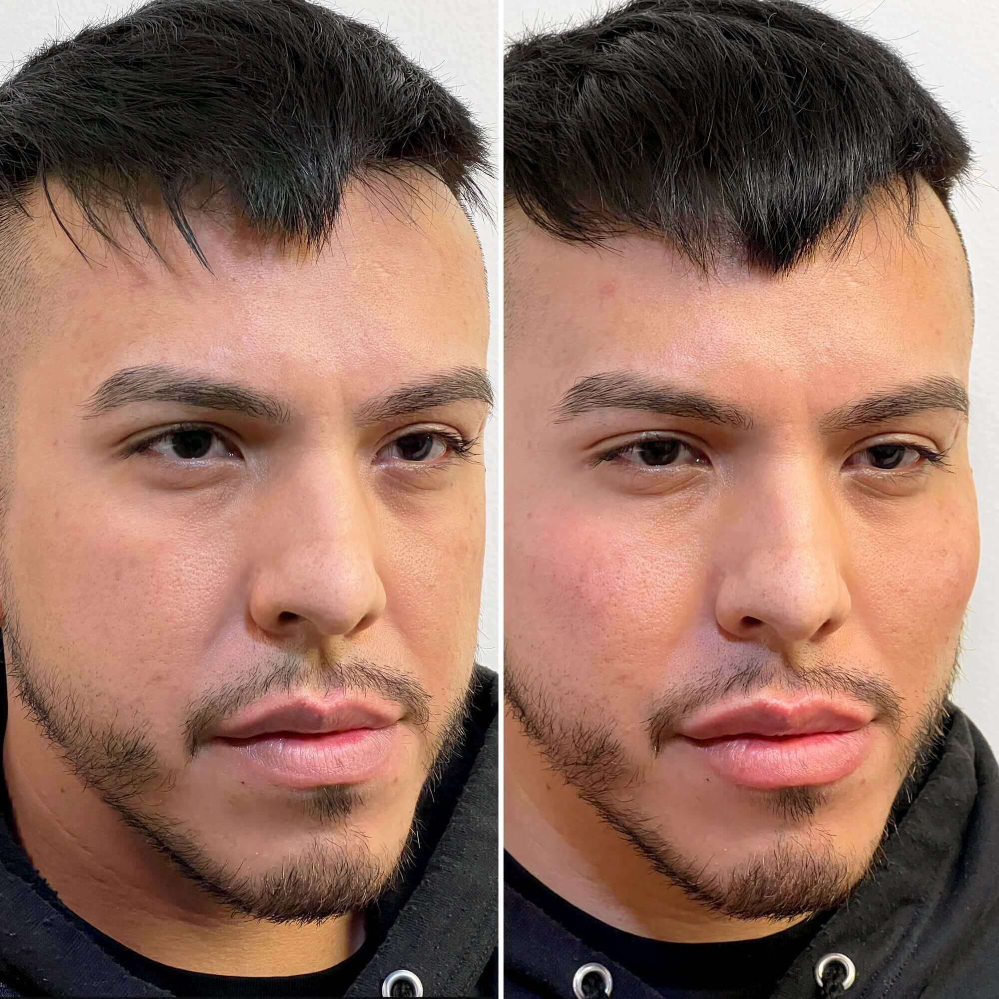 FaceFix: Face Lift for Men – Beauty Fix MedSpa