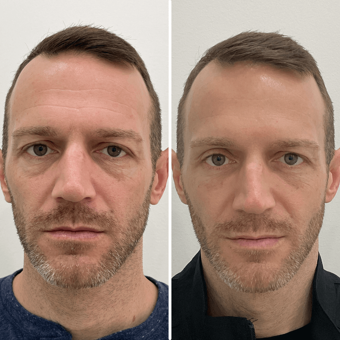 FaceFix: Face Lift for Men – Beauty Fix MedSpa