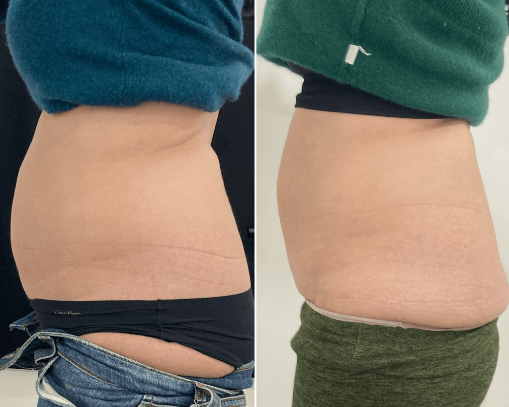 BodyFix: CoolSculpting® Elite – Beauty Fix MedSpa