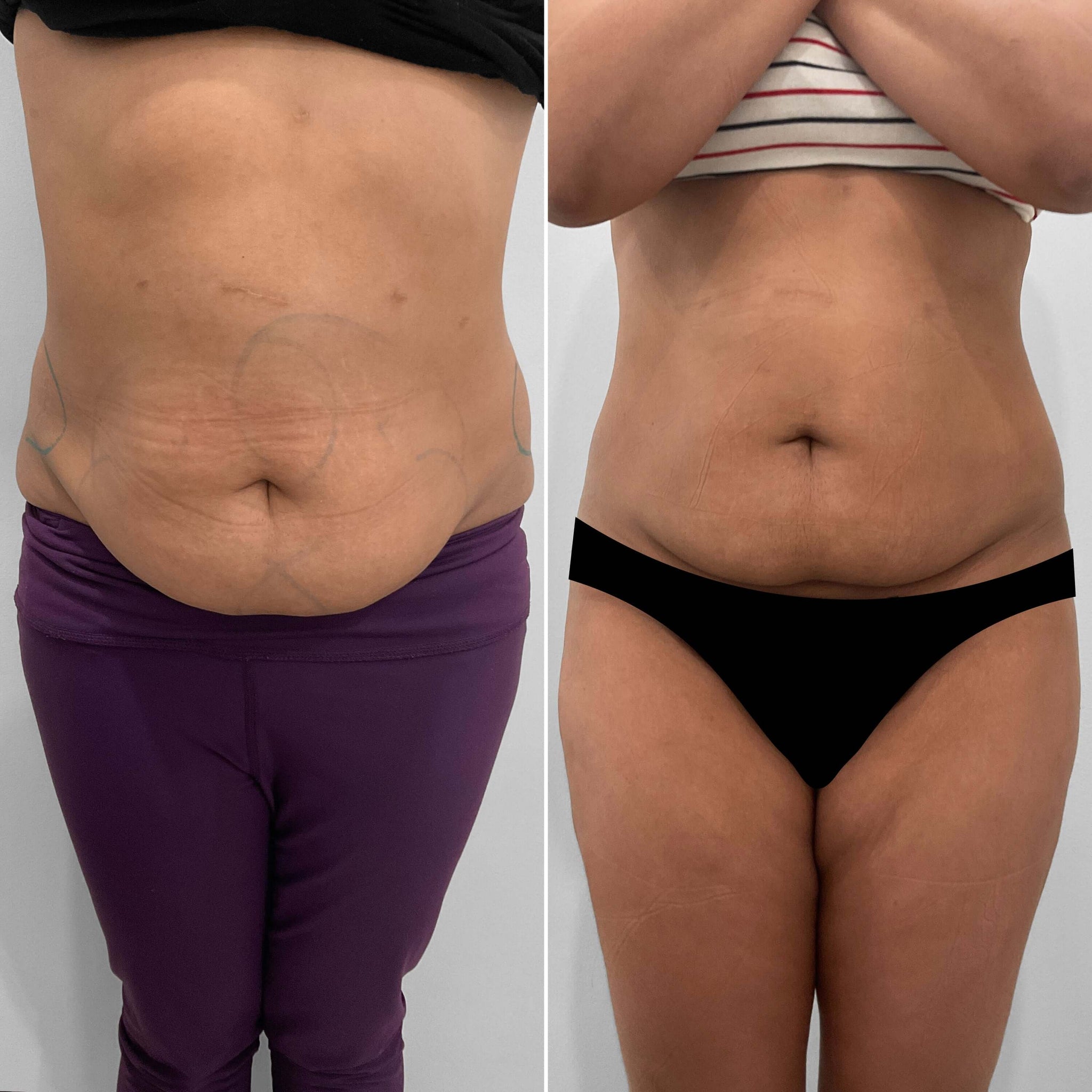BodyFix: CoolSculpting® Elite – Beauty Fix MedSpa
