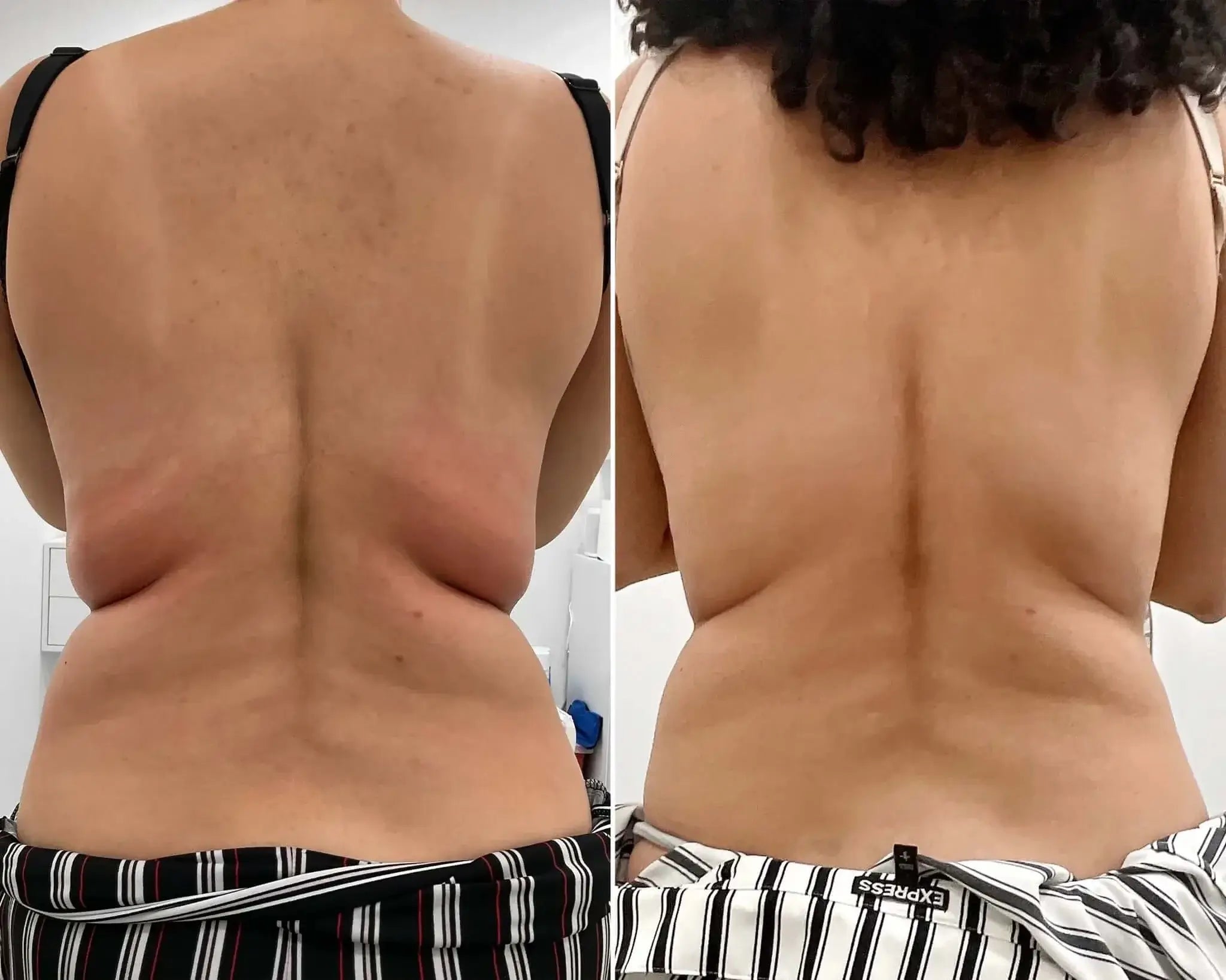 BodyFix: Kybella – Beauty Fix MedSpa