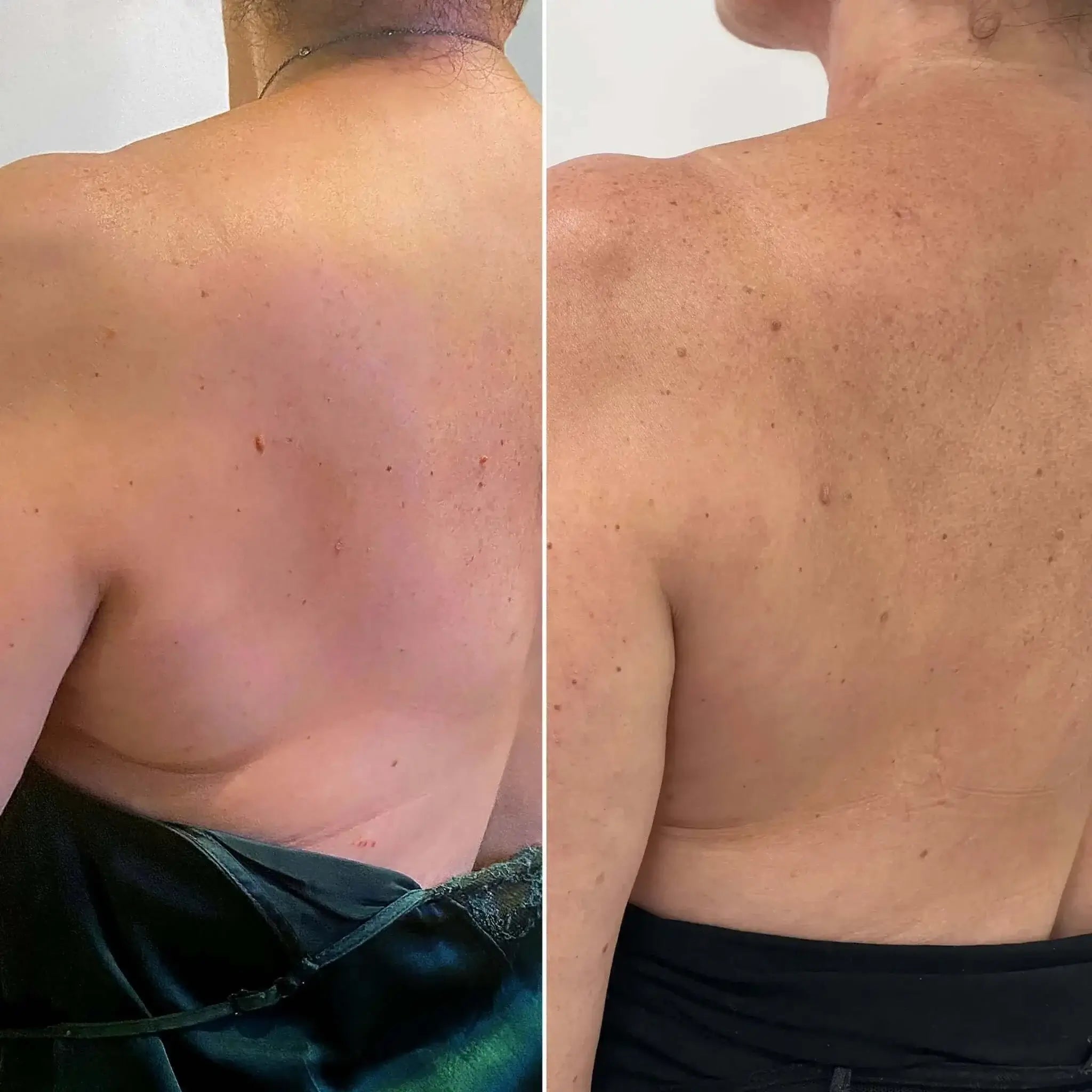 BodyFix: Kybella – Beauty Fix MedSpa