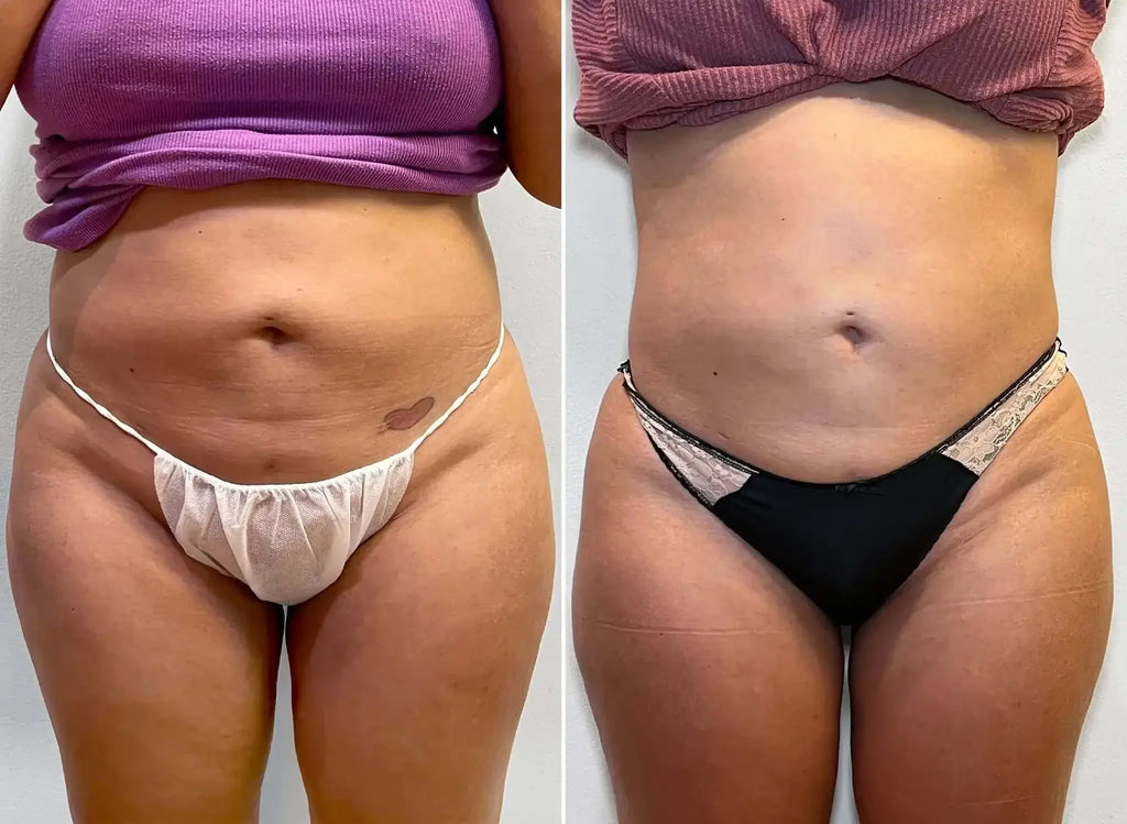 BodyFix: Kybella – Beauty Fix MedSpa