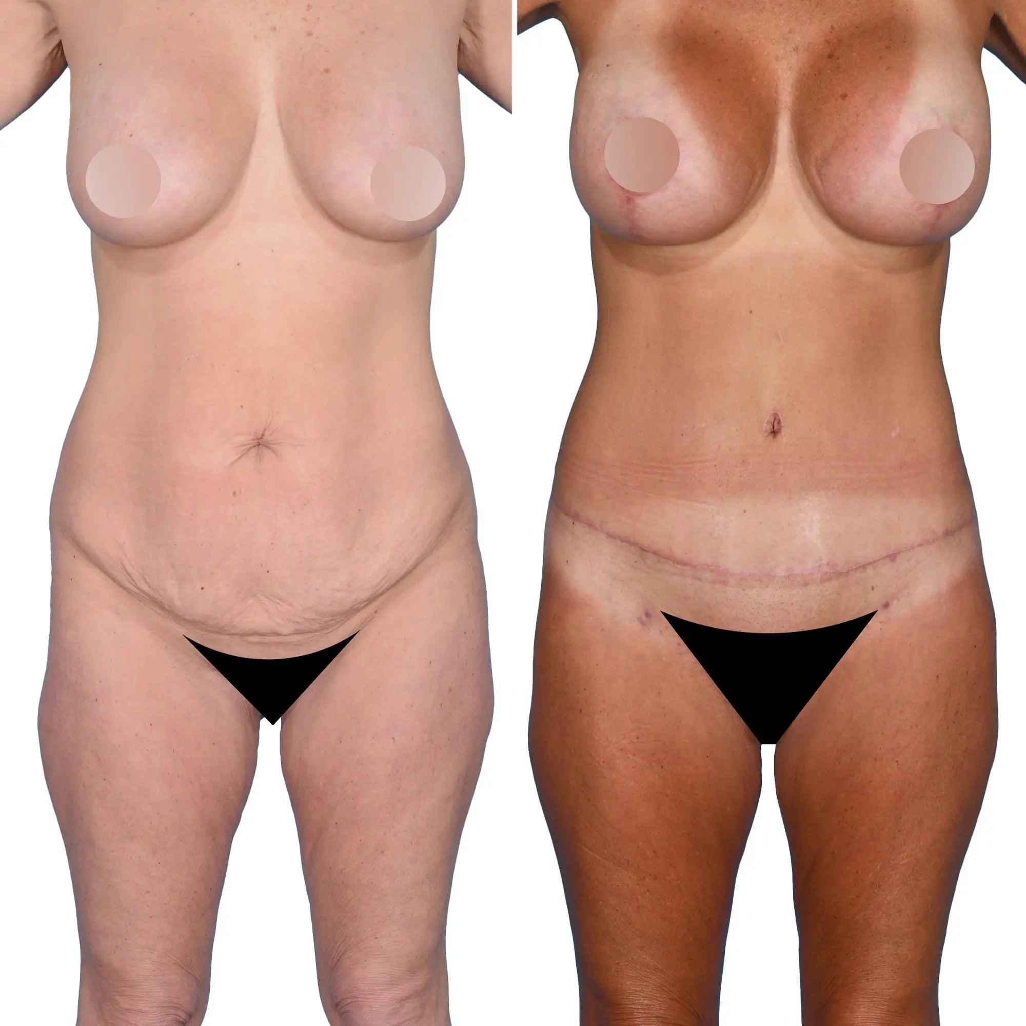 BodyFix: Tummy Tuck – Beauty Fix MedSpa
