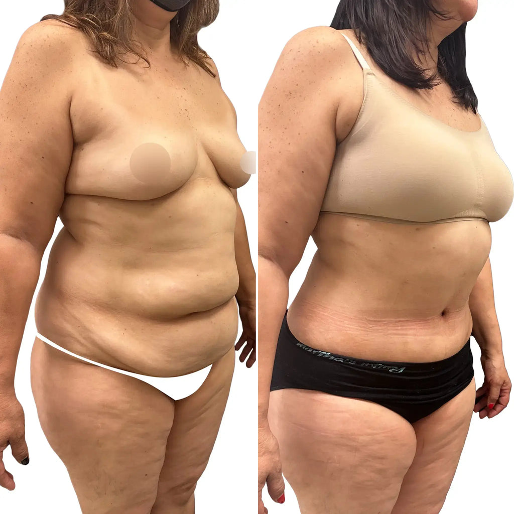 BodyFix: Tummy Tuck – Beauty Fix MedSpa