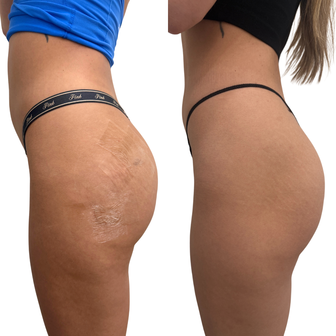 BootyFix: Glow Shots – Beauty Fix MedSpa