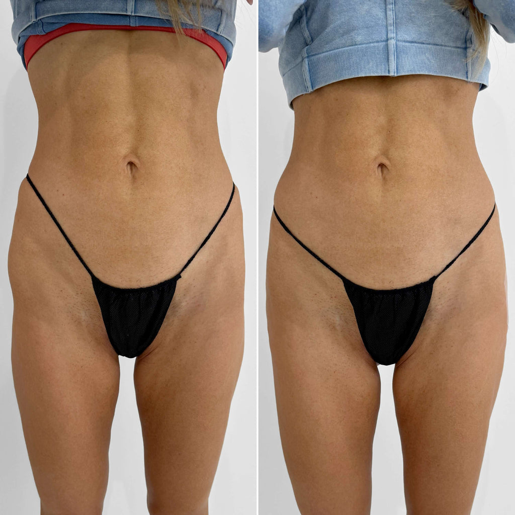 BootyFix: Skinny BBL – Beauty Fix MedSpa