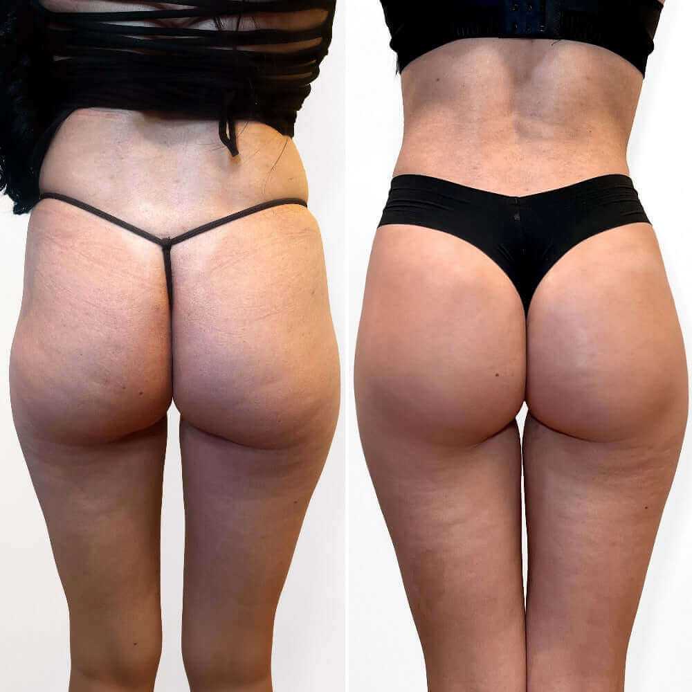 BootyFix: Radiesse Butt Lift