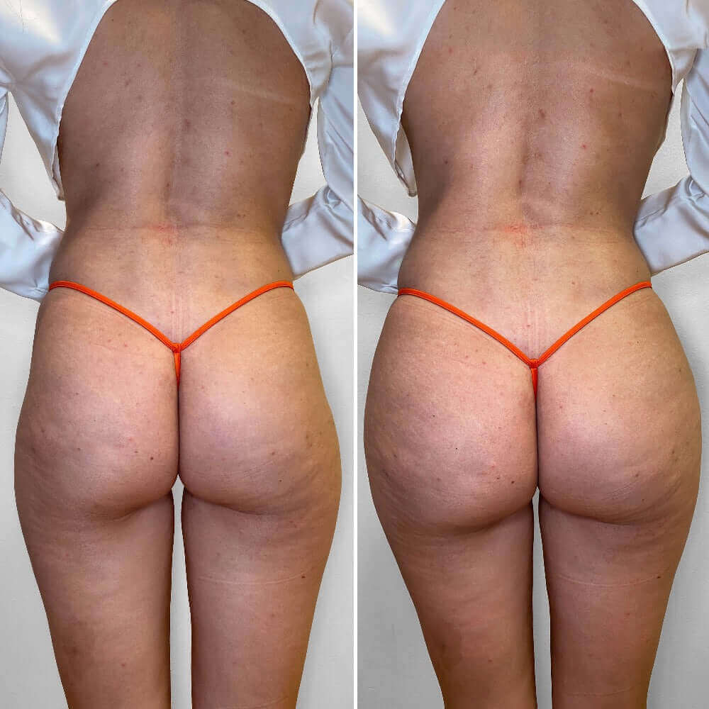 BootyFix: Radiesse Butt Lift – Beauty Fix MedSpa