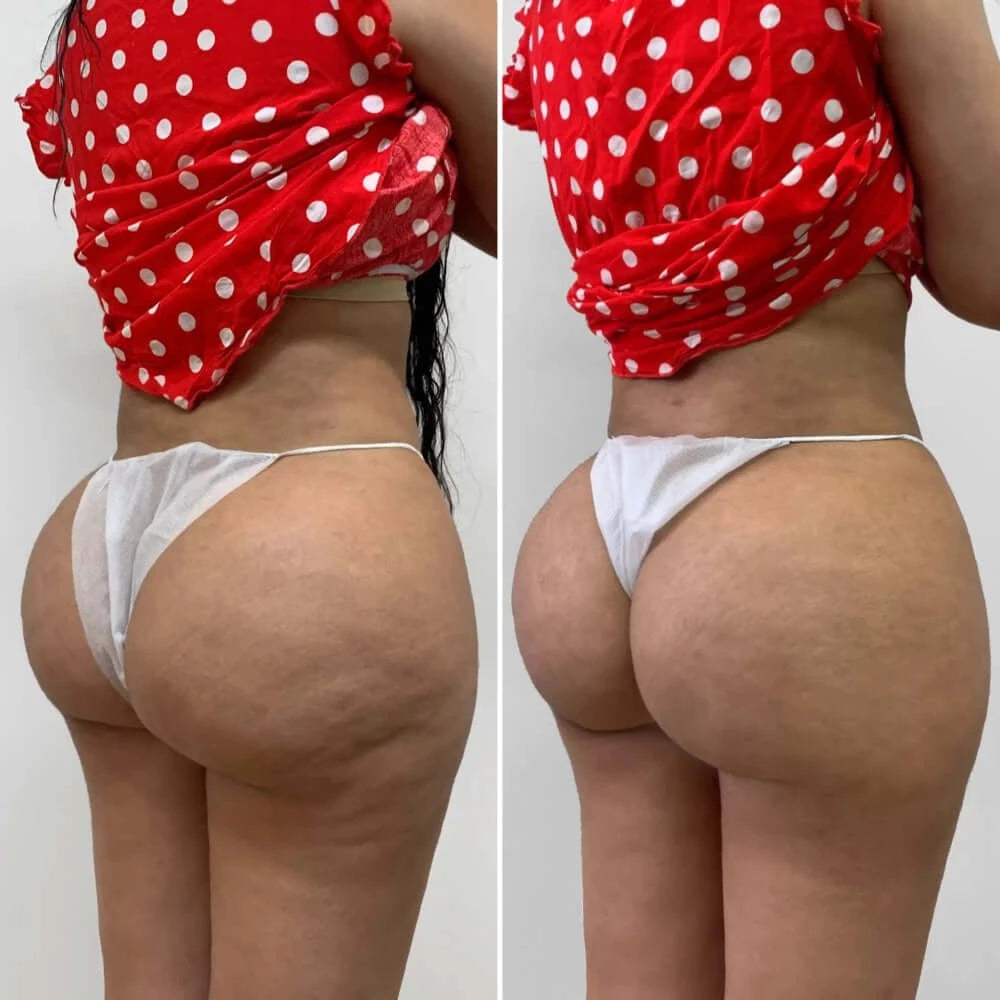 BootyFix: Radiesse Butt Lift – Beauty Fix MedSpa