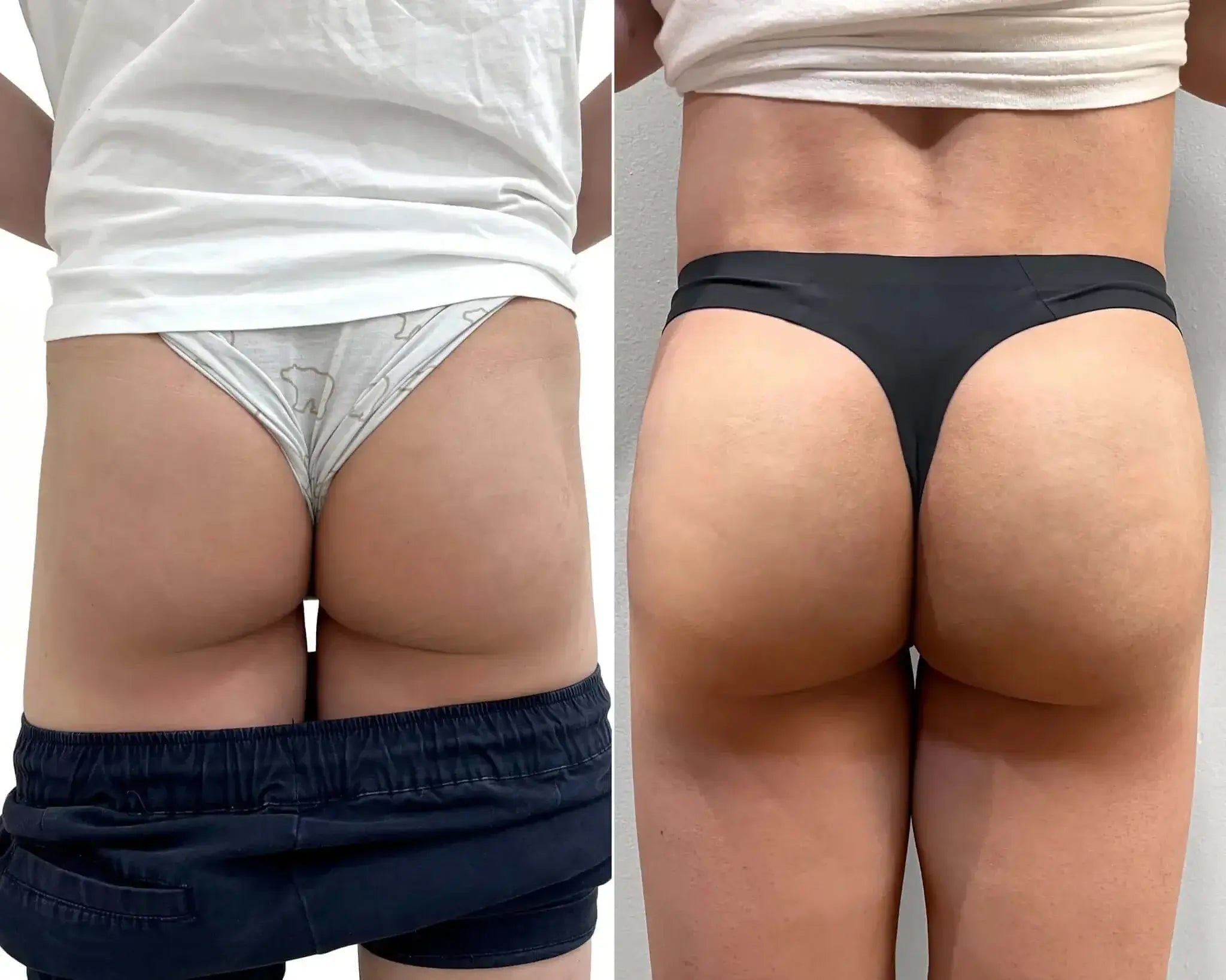 BootyFix: Renuva Butt Lift – Beauty Fix MedSpa