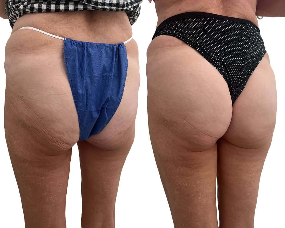 BootyFix: Sculptra Butt Lift – Beauty Fix MedSpa