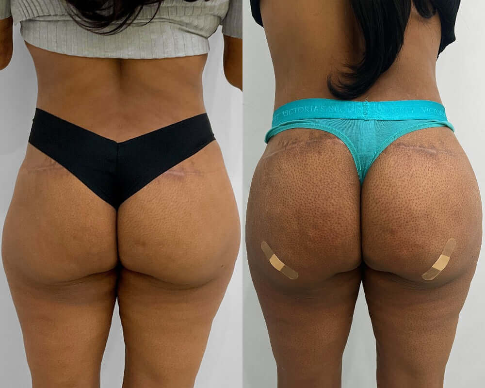 BootyFix: HipDips – Beauty Fix MedSpa