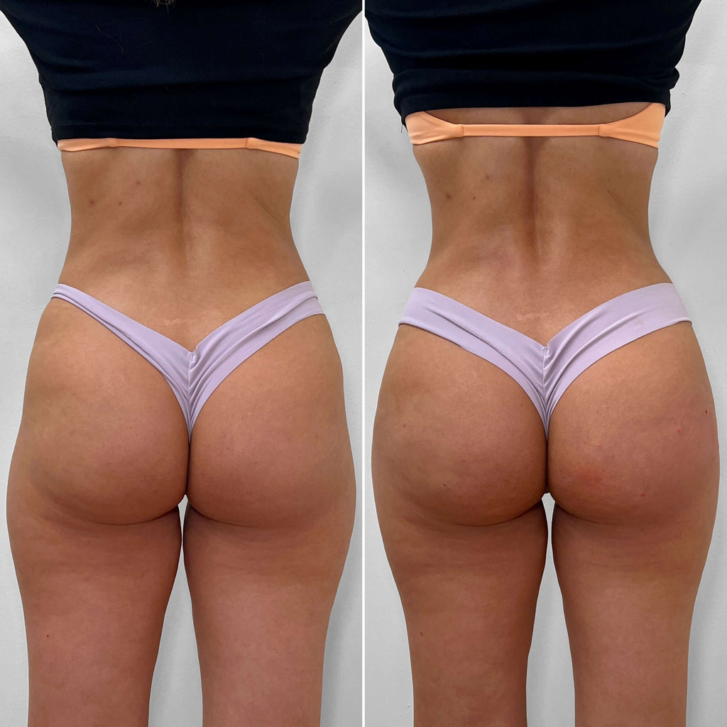 BootyFix: Sculptra Butt Lift – Beauty Fix MedSpa