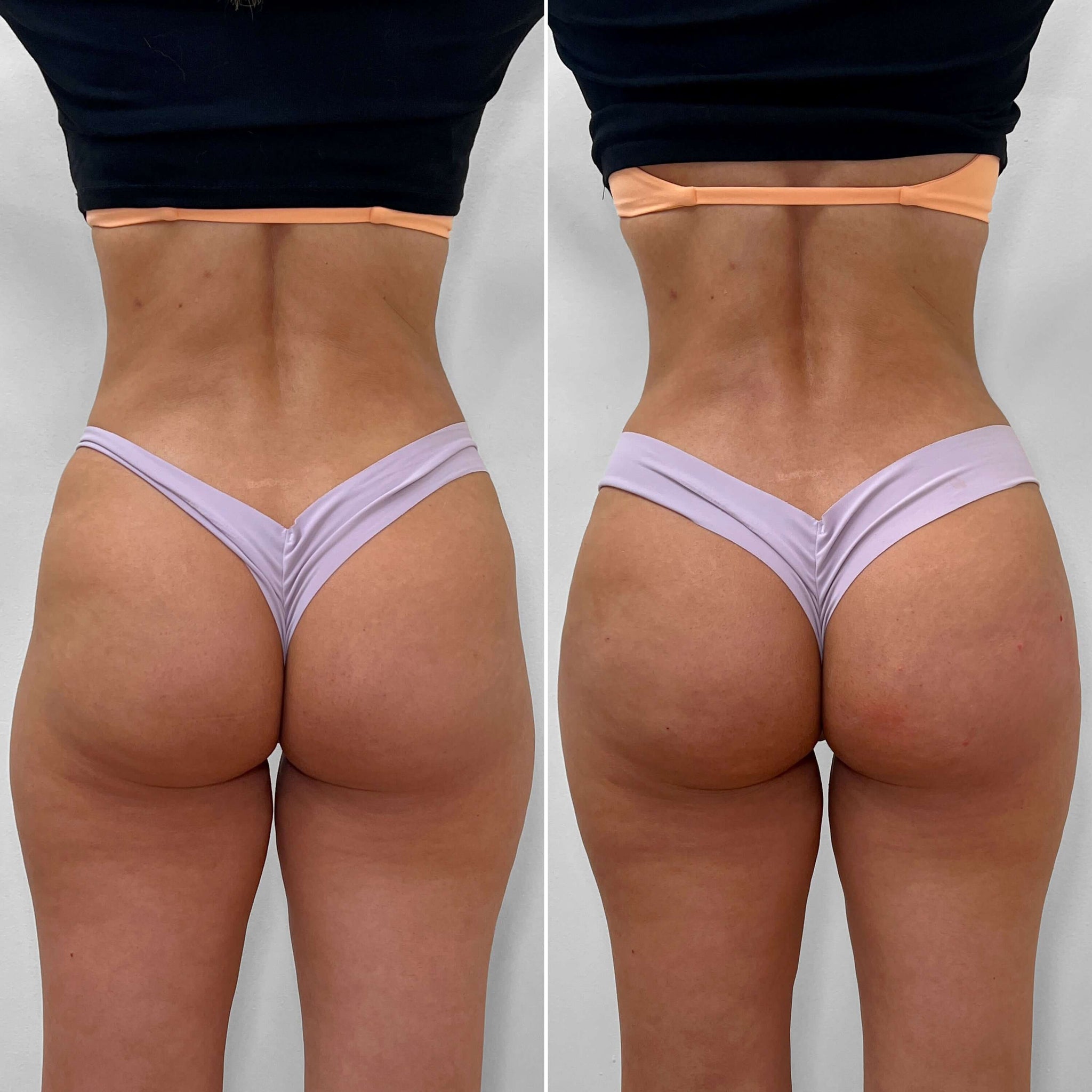 BootyFix: Sculptra Butt Lift – Beauty Fix MedSpa