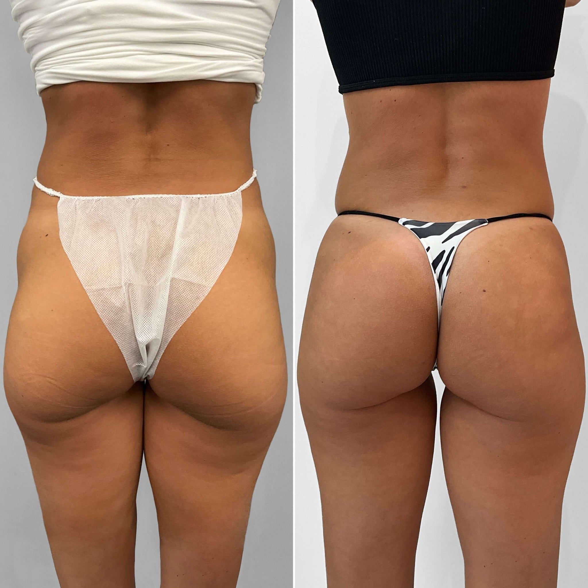 BootyFix: Sculptra Butt Lift – Beauty Fix MedSpa