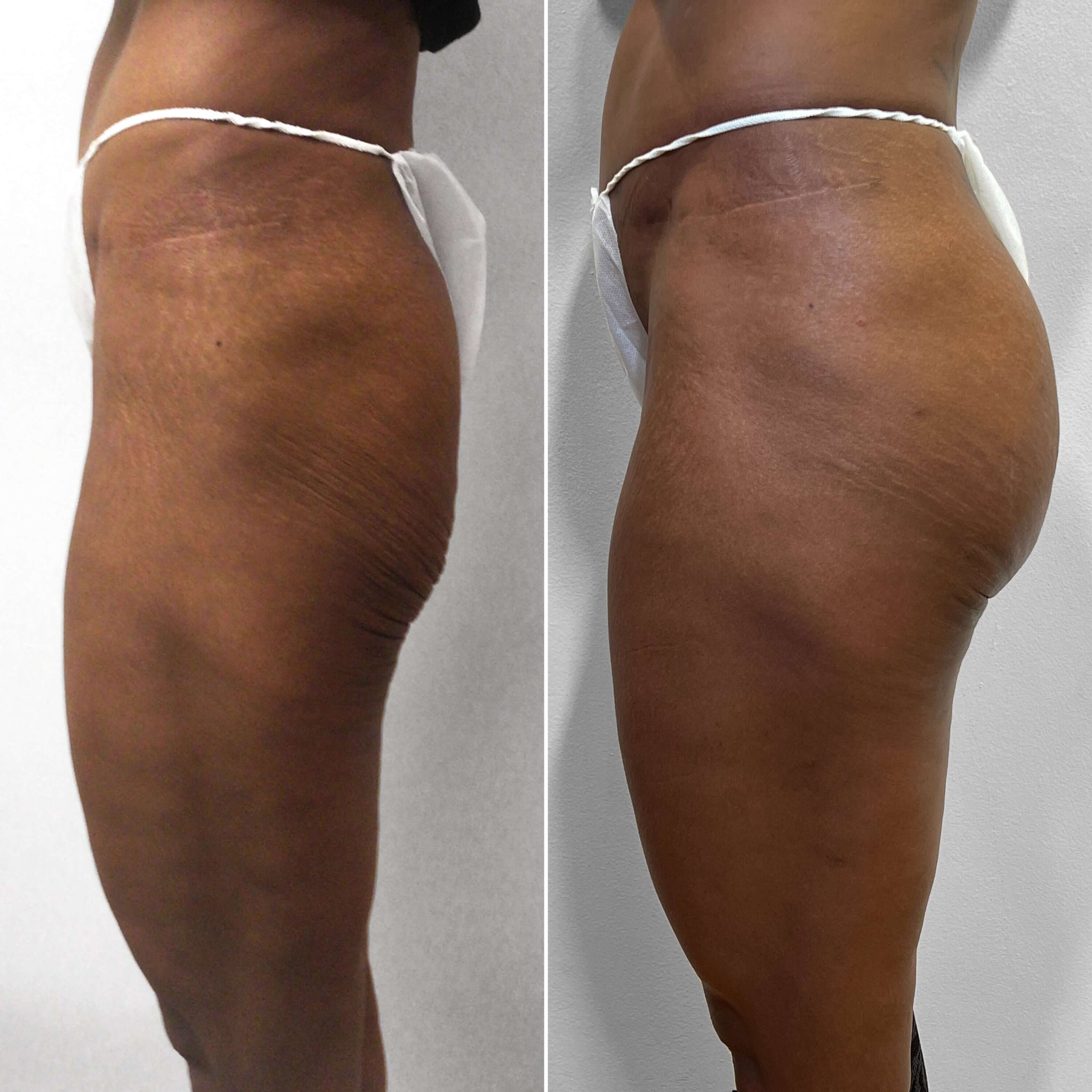 BootyFix: Sculptra Butt Lift – Beauty Fix MedSpa