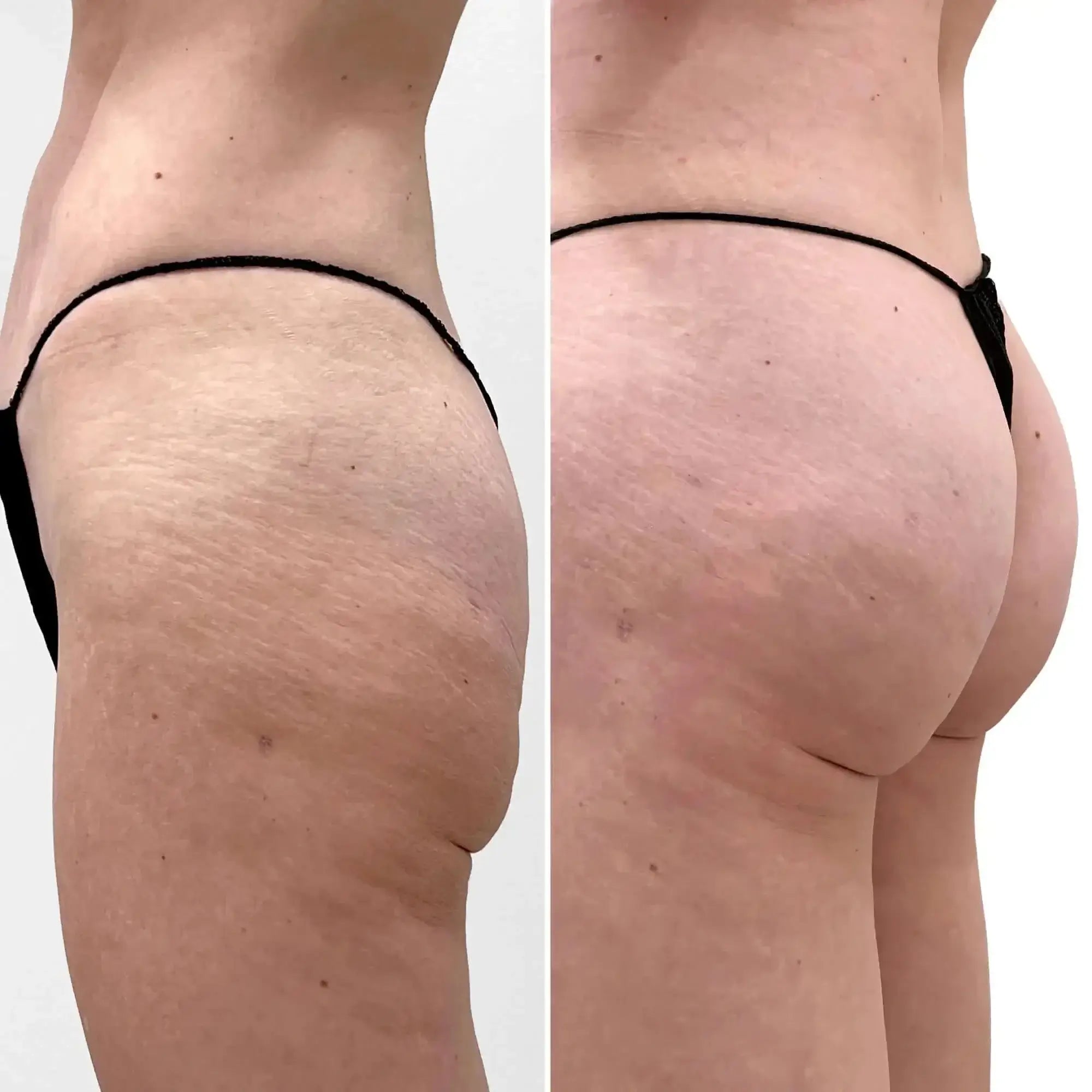 BootyFix: Renuva Butt Lift – Beauty Fix MedSpa