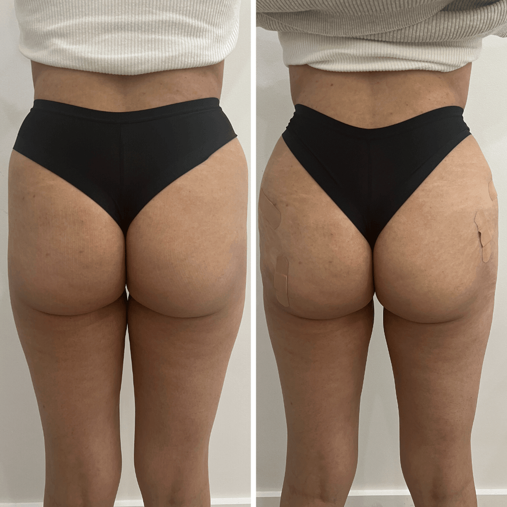 BootyFix: Sculptra Butt Lift – Beauty Fix MedSpa