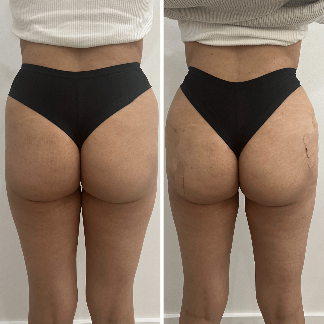 BootyFix: Sculptra Butt Lift – Beauty Fix MedSpa