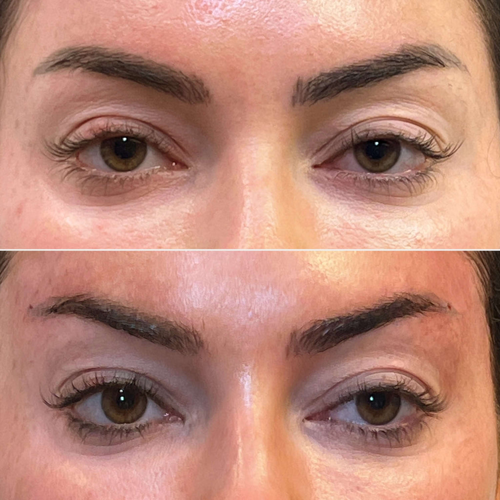 PDO Thread Brow Lift