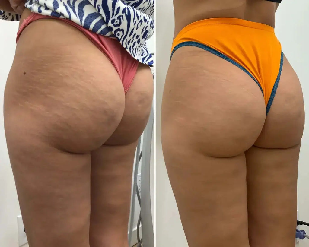 CelluliteFix: Venus – Beauty Fix MedSpa