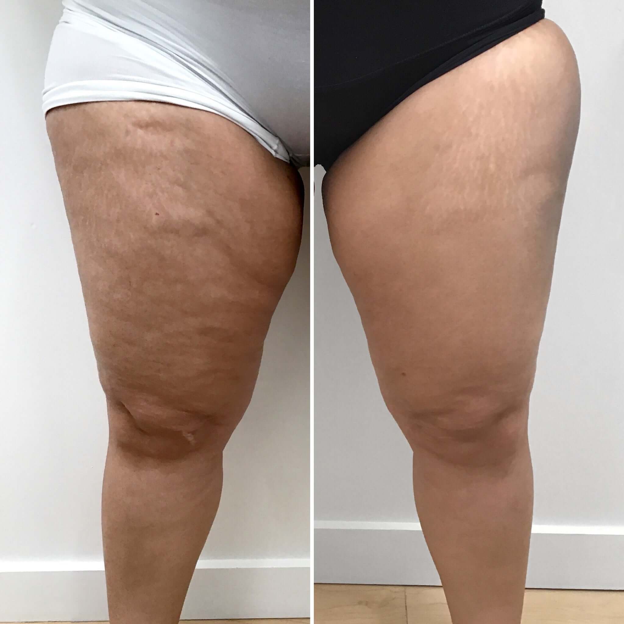 CelluliteFix: Venus | BeautyFix MedSpa - (212) 366-4787