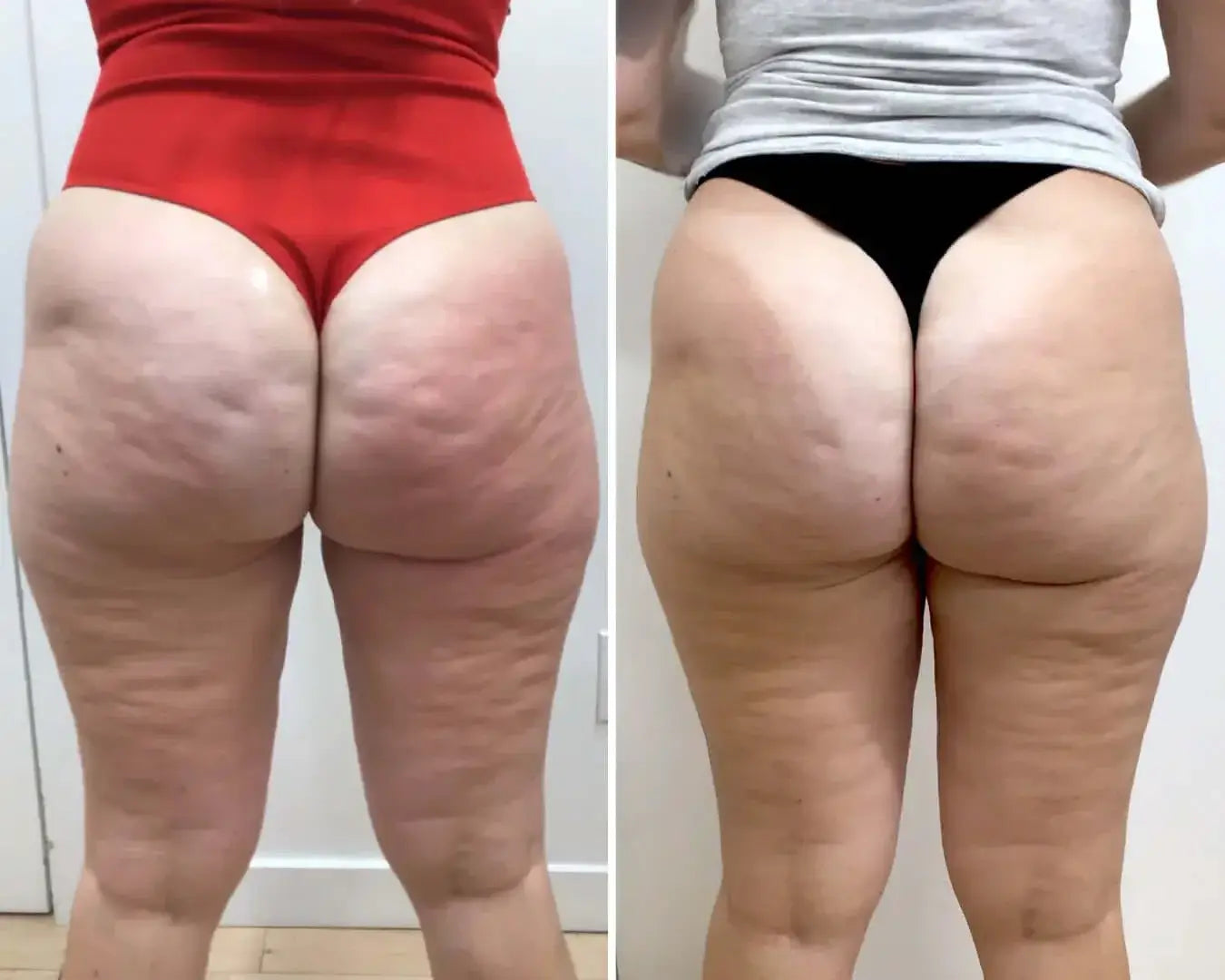 CelluliteFix: Venus – Beauty Fix MedSpa