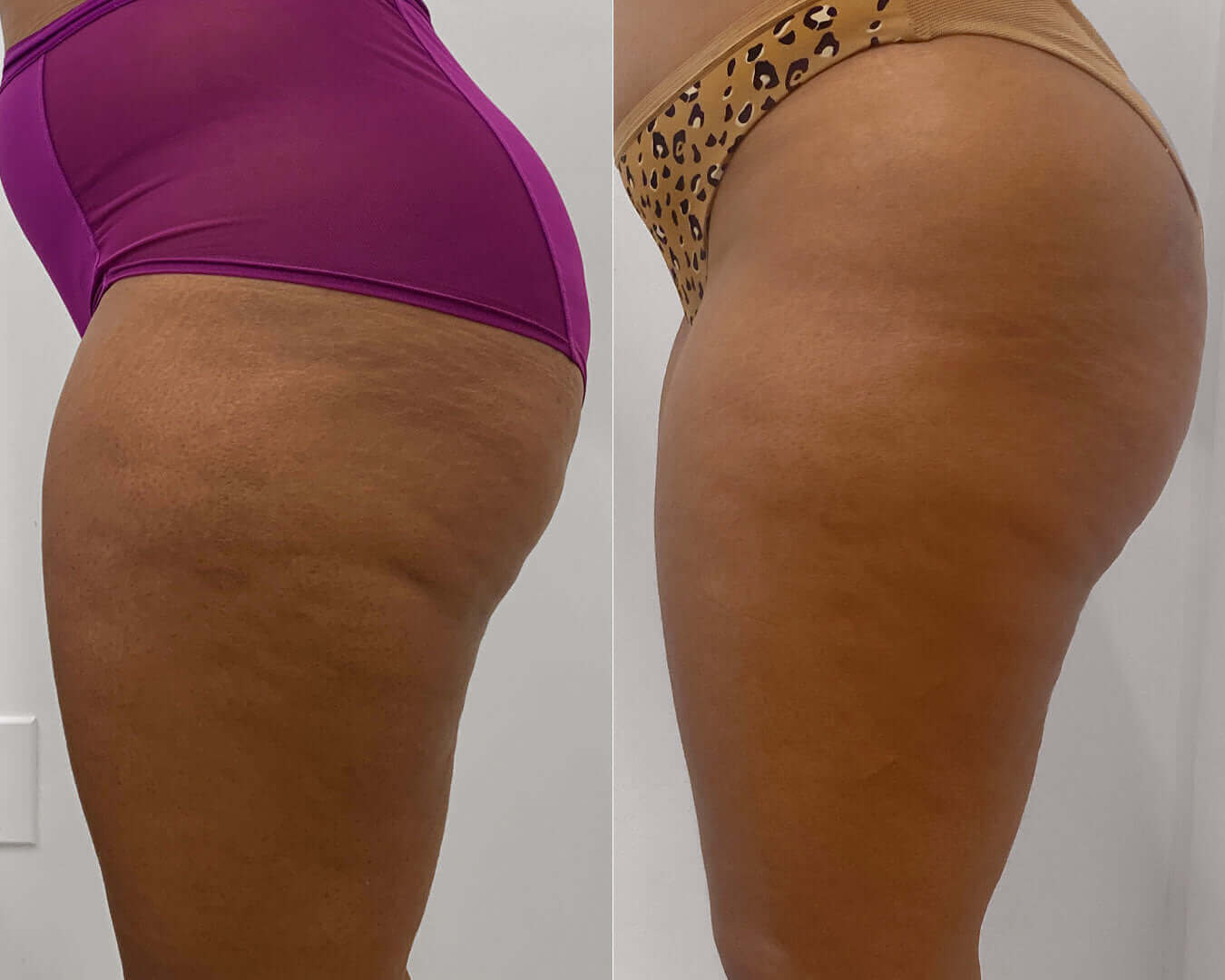 CelluliteFix: Venus | BeautyFix MedSpa - (212) 366-4787